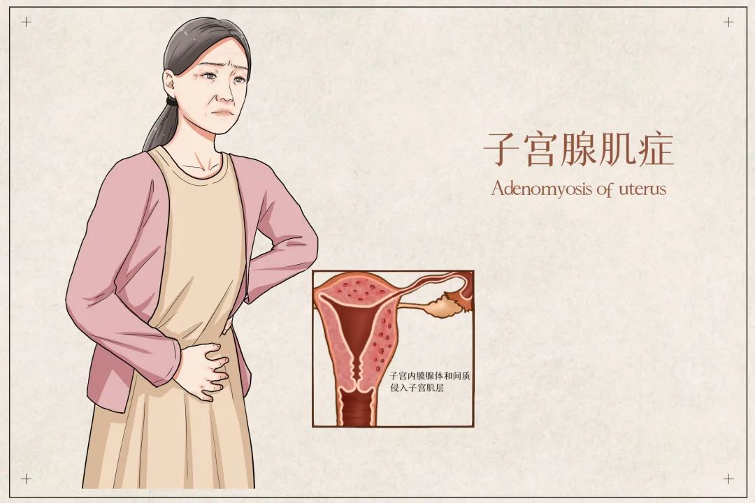 子宫腺肌症是良性吗,子宫腺肌病属于重大疾病吗