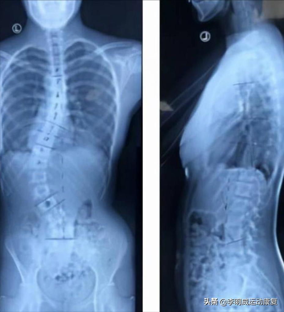 14岁脊柱向左侧弯13度要怎么矫正,14岁脊柱侧弯40度不治疗会加重呀