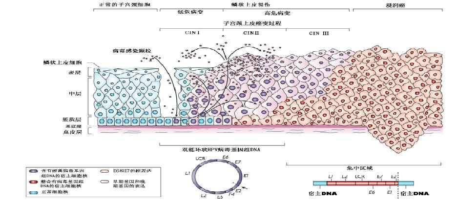 派特灵派特生物精选｜CIN的规范化诊治