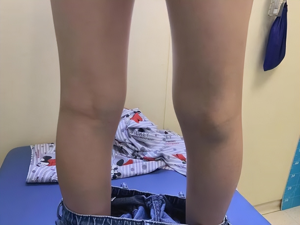 腿弯长了个包？小心是腘窝囊肿