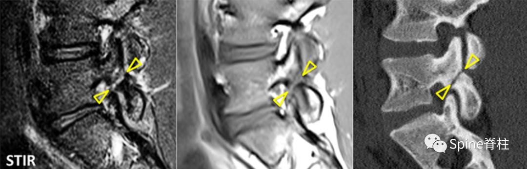 轻度峡部裂和重度峡部裂的区别,真性峡部裂和假性峡部裂