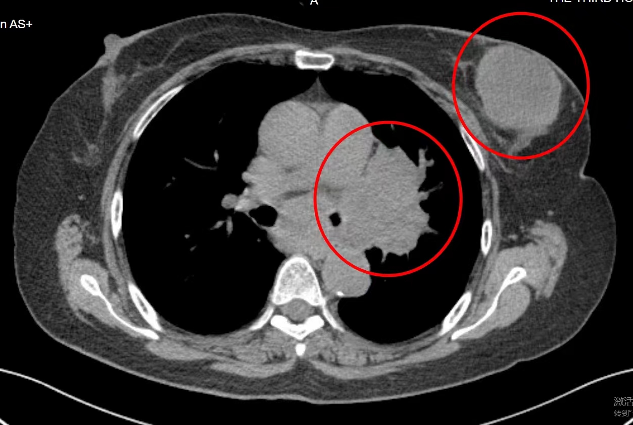 肿瘤变小但是转移了怎么办,乳腺癌术后几年肺转移有什么症状