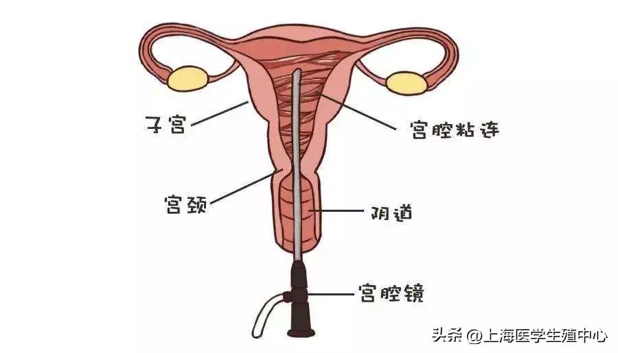 试管不能着床有必要做宫腔镜吗,胚胎移植着床失败后要做宫腔镜吗