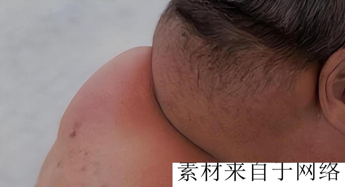 酗酒40年喝成河马脖,辽宁男子喝酒达三万斤