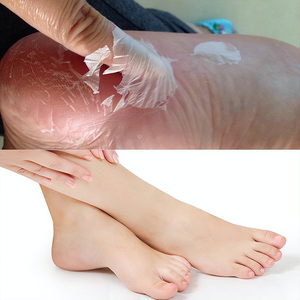 鐨偆绮楃硻鏆楁矇姣涘瓟绮楀ぇ鎬庝箞鏀瑰杽,姣涘瓟绮楀ぇ濡備綍鏀瑰杽鏈夋晥