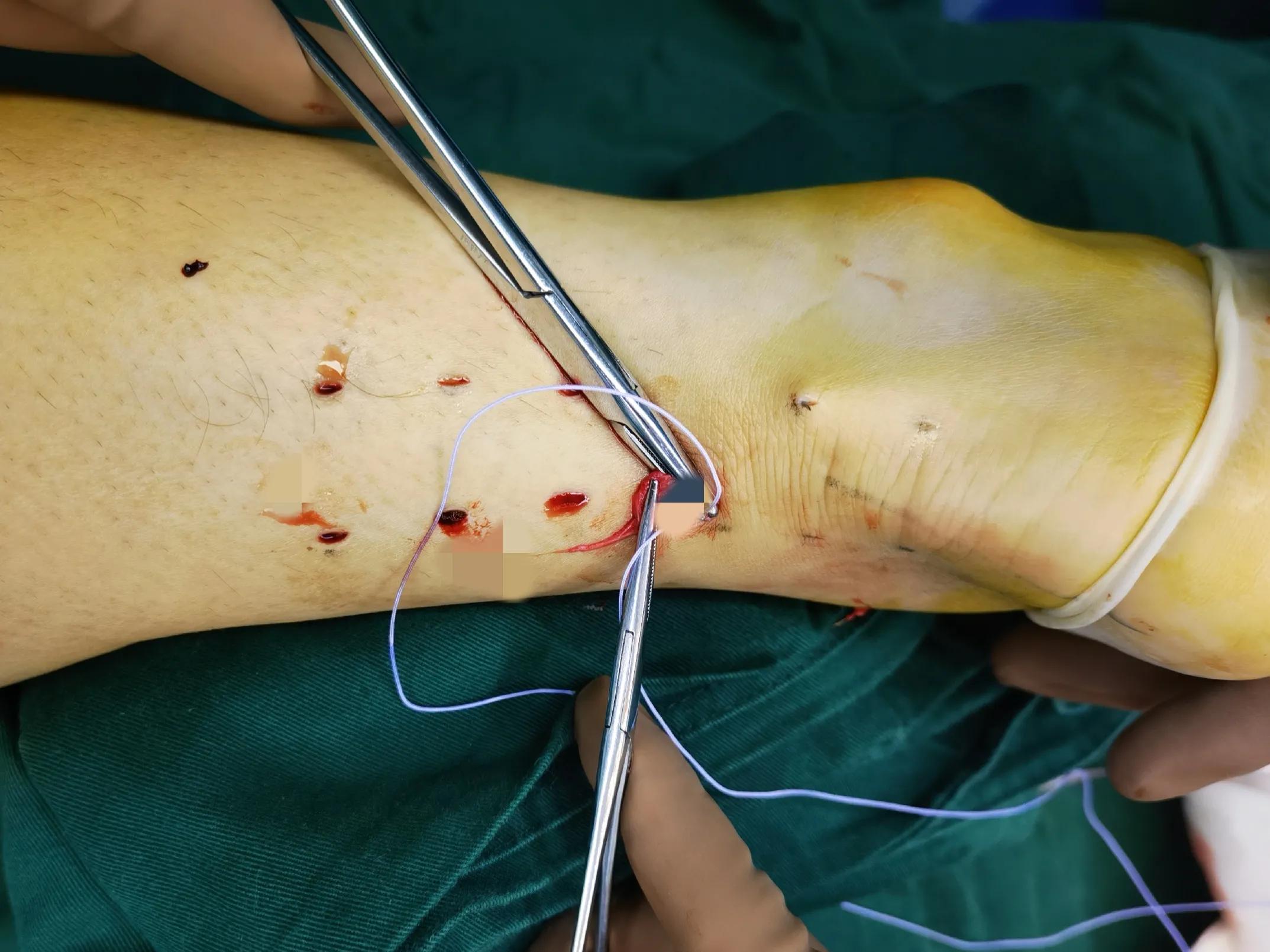 跟腱断裂的微创治疗,跟腱断裂微创手术修复演示图