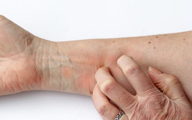 身上起小红点点是不是hpv,身上有红色的小血点是不是hpv