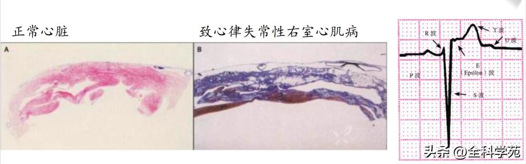 t波倒置三种常见原因,t波低平倒置有事吗
