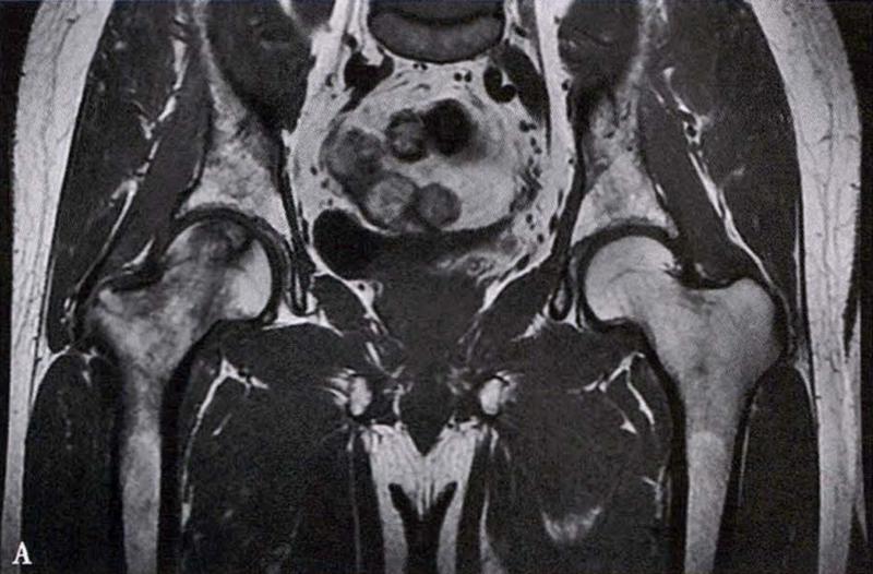 全国十大股骨头坏死诊疗中心,股骨头坏死诊疗方法有哪些