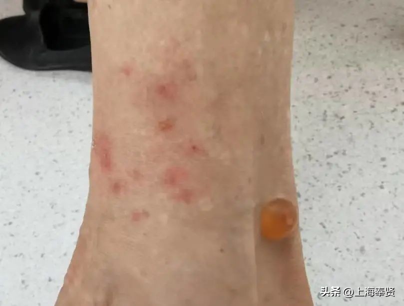 夏天虫咬皮炎的治疗方法,虫咬性皮炎到底如何杀虫