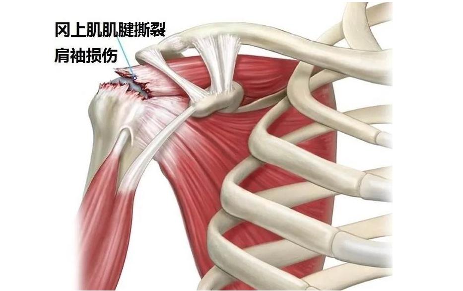 肩膀疼运动一下,运动肩膀疼痛怎么治疗最快最好