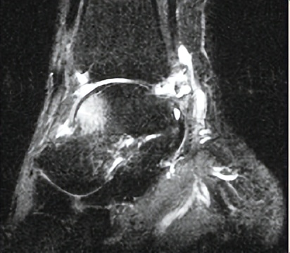 脚踝疼痛别大意，警惕这个疾病找上门！