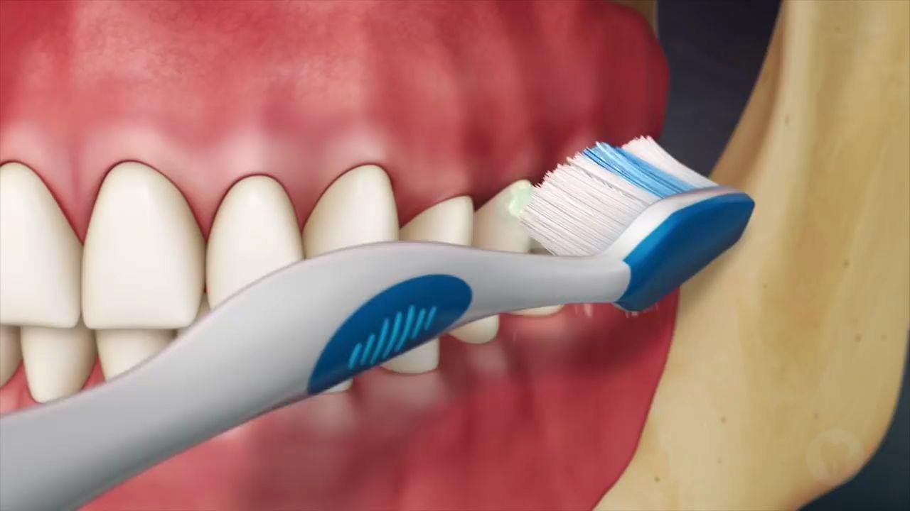 牙缝有牙结石怎么去除,牙缝间的牙结石怎么清除