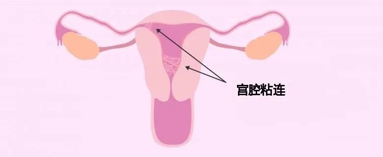 宫腔粘连影响生育吗?要怎么处理?