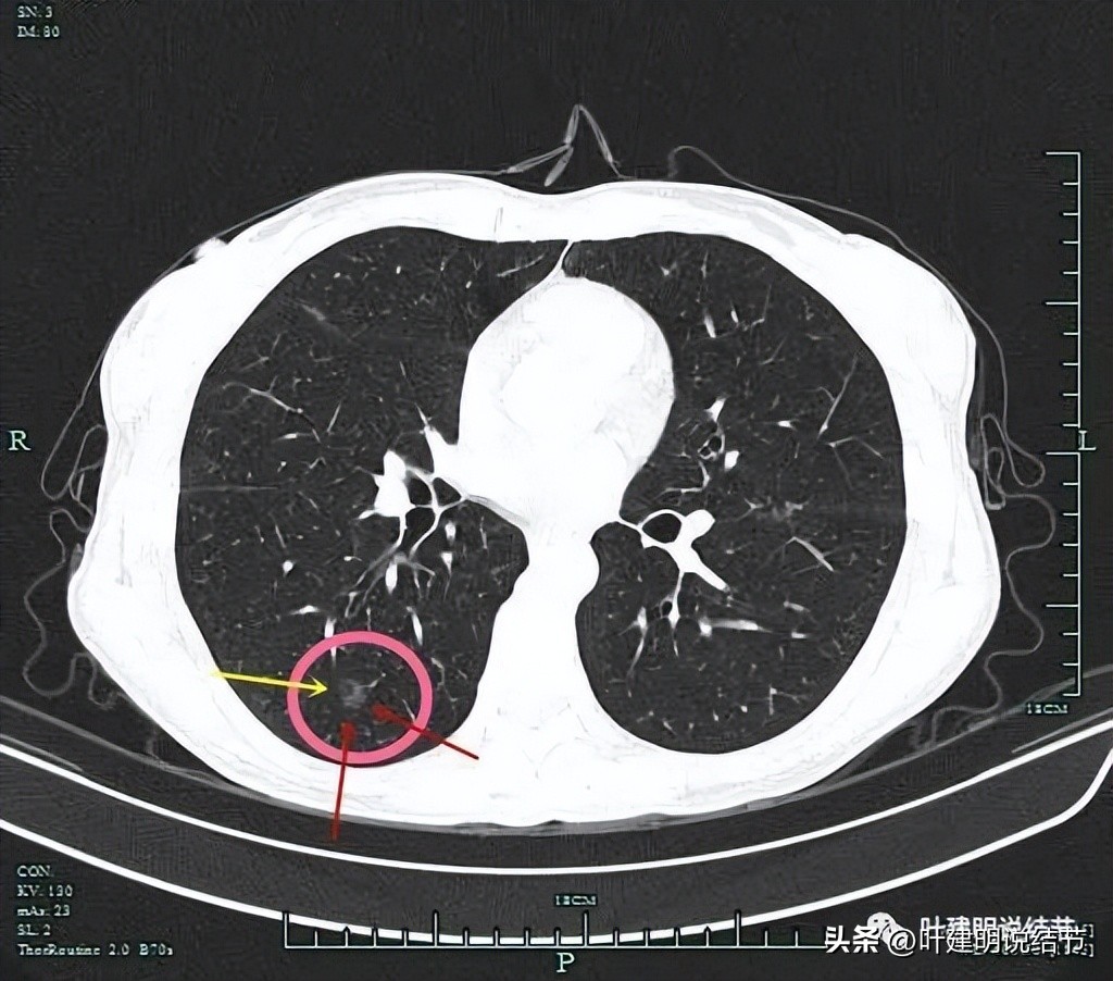右下叶磨玻璃结节5*4,右下叶磨玻璃样结节多为炎性