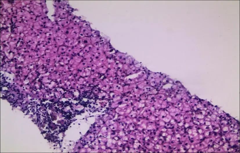 慢性乙肝患者牙龈出血意味着什么,乙肝抗病毒后牙龈出血是什么原因