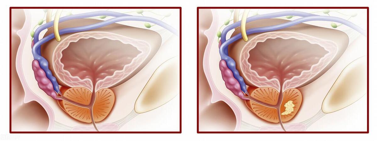 喝完水就想小便是不是肾出了问题,喝完水就想尿是肾好还是不好