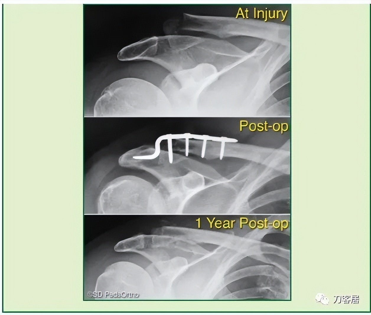 儿童锁骨骨折保守治疗的弊端,锁骨粉碎骨折错位不处理会愈合吗