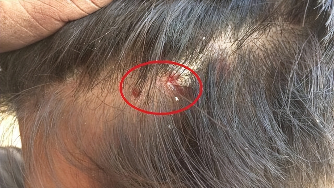 头皮后脑勺长红疙瘩有脓包,为什么头皮上总是长脓包和痘痘