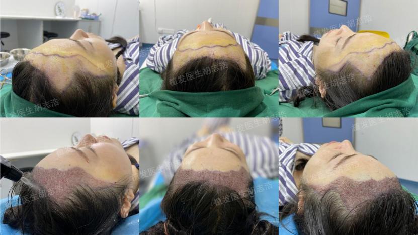 植发后后枕部的头发多久能恢复,植发手术后3个月恢复过程