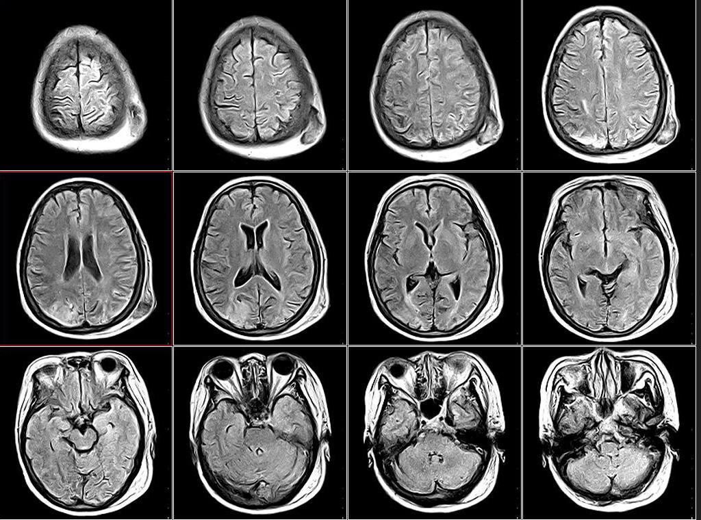 Machado-Joseph病是常染色体显性遗传病，目前没有特定的治疗方法