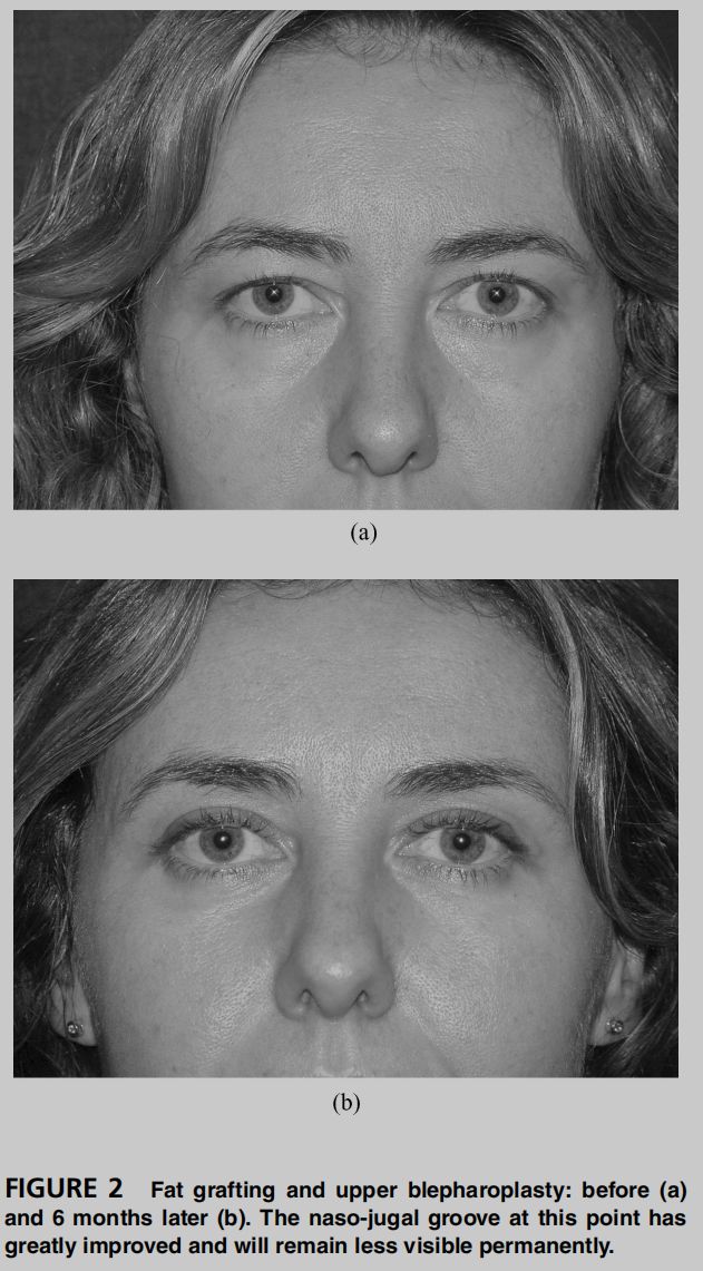 印第安纹解剖学,印第安纹分型对策