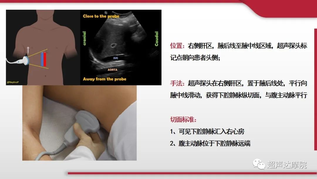 超声下腔静脉评估血容量,超声评估下腔静脉容量图片