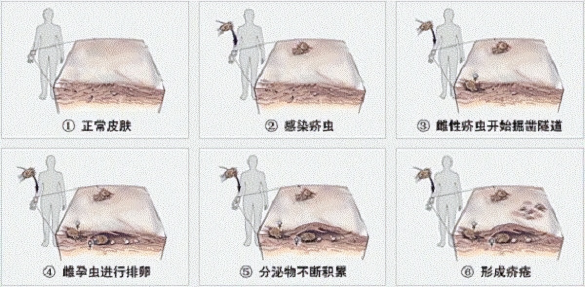 疥疮会引起腹痛吗,灼热疼痛怎么回事