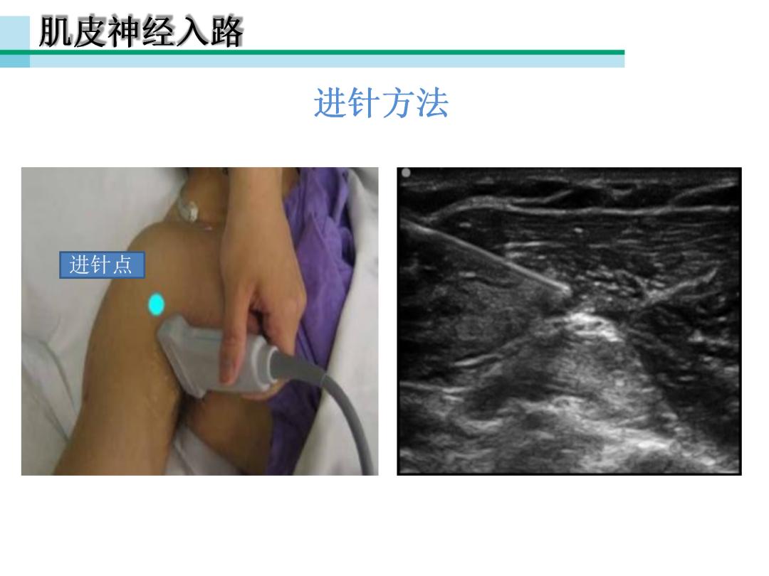 超声引导下臂丛神经阻滞,PPT课件