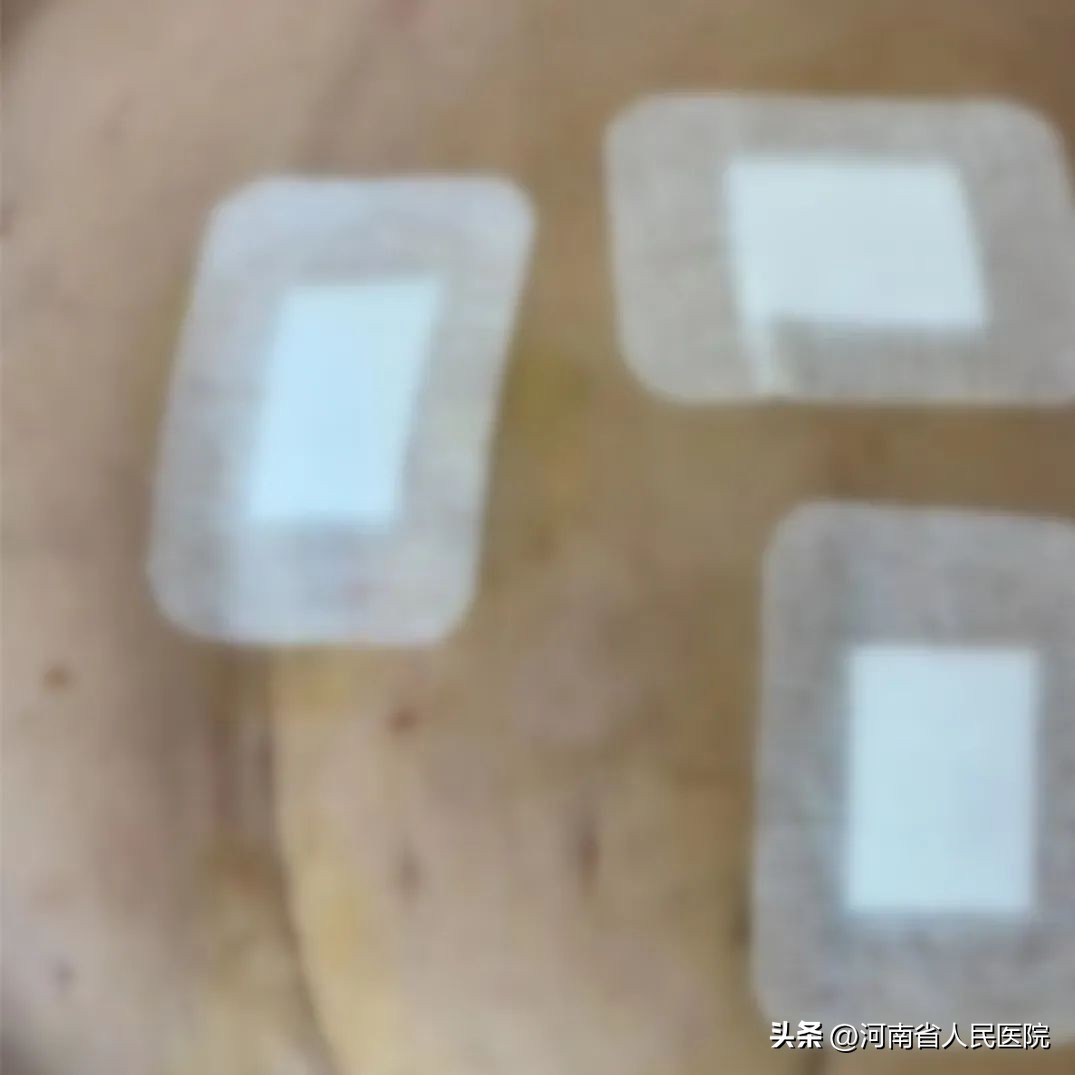 全省首例！微创切口再升级，完成直肠癌手术