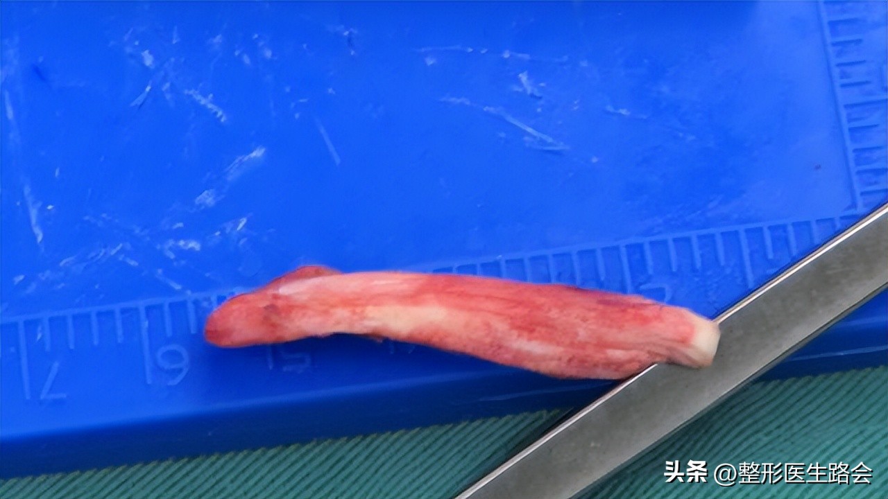 硅胶隆鼻后鼻尖发红怎么回事,单纯硅胶隆鼻一分钟搞定