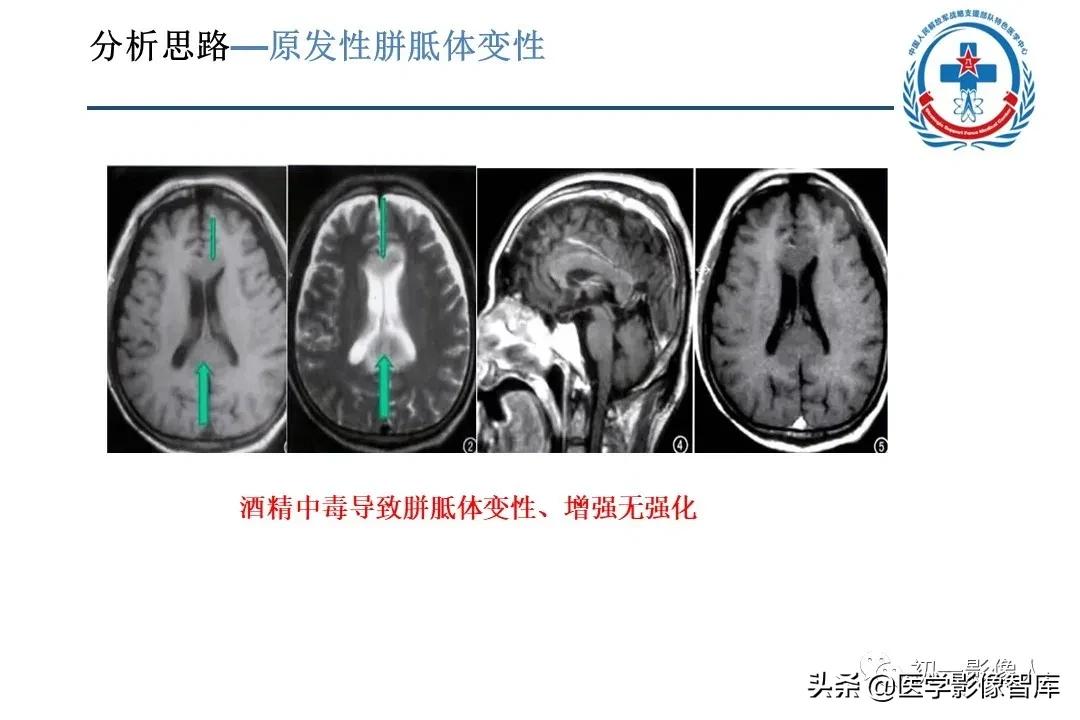 胼胝体变性治疗方法,原发性胼胝体病变治疗