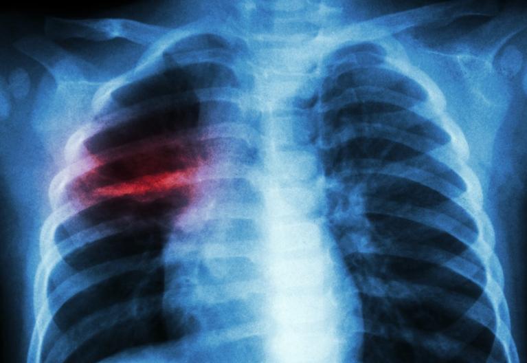 小儿肺炎怎么彻底治疗,小儿肺炎如何彻底治疗