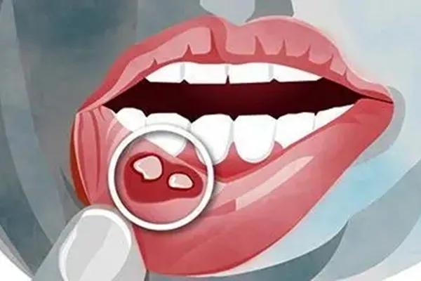 类风湿严重会有什么后果,类风湿严重了会得强直性脊柱炎吗