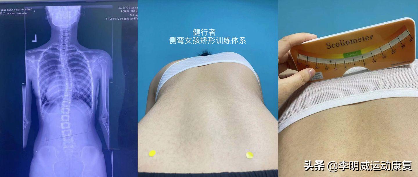 14岁男孩脊柱侧弯怎么训练,14岁女孩脊柱侧弯以后还会加重吗