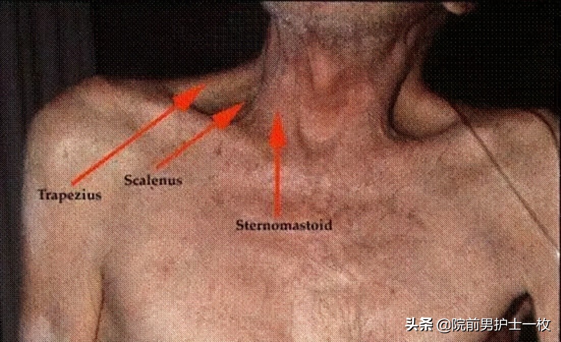 紧急救援海姆立克急救法,三分钟学会海姆立克急救法