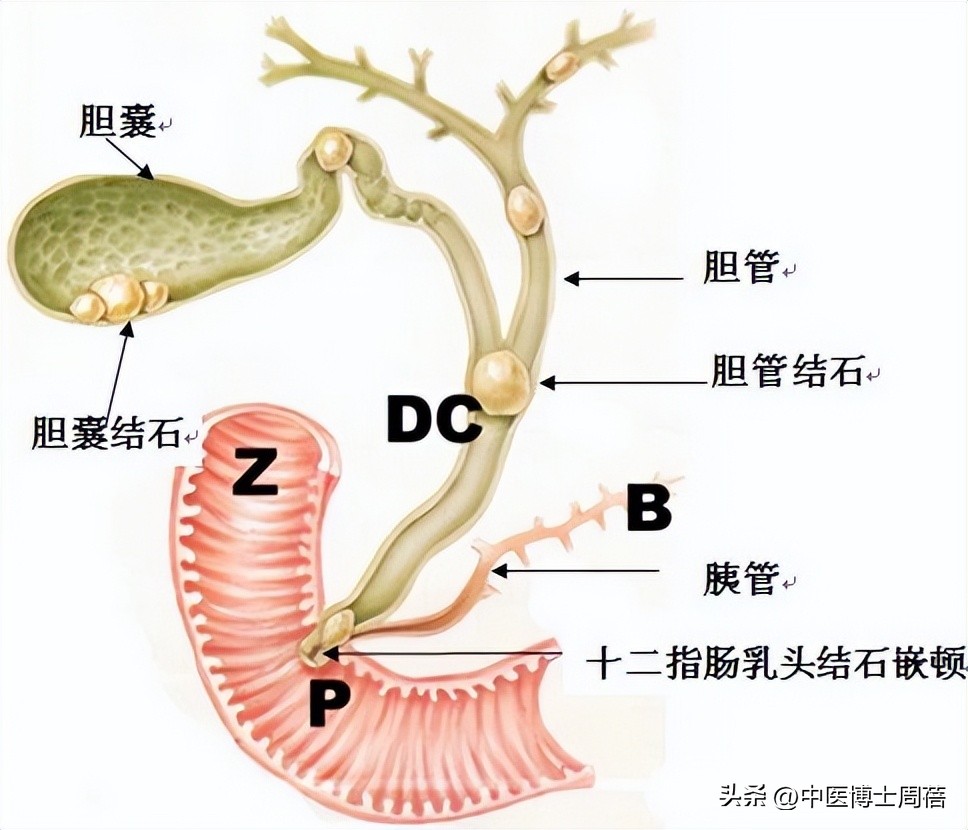 胆结石服用中药可以排出来吗,胆囊息肉结石可以用中药来治疗吗