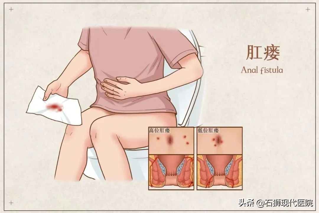 肛门处有分泌物如何自我判断？有哪些应急处理方法？