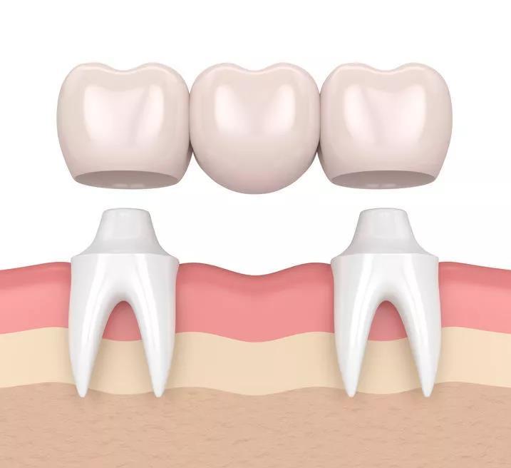 植得口腔树脂修复门牙,植得口腔医院矫正怎样