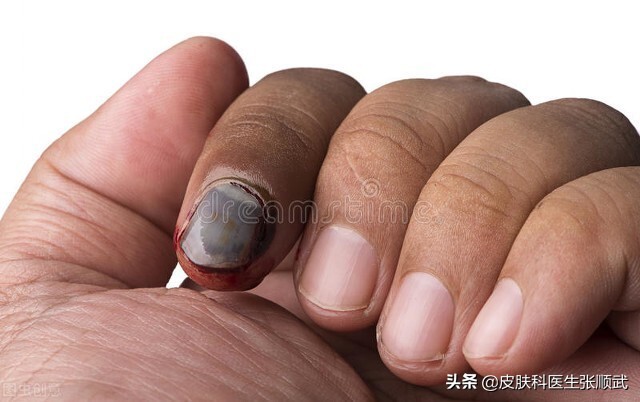 灰指甲老不好,这种方法教给大家?