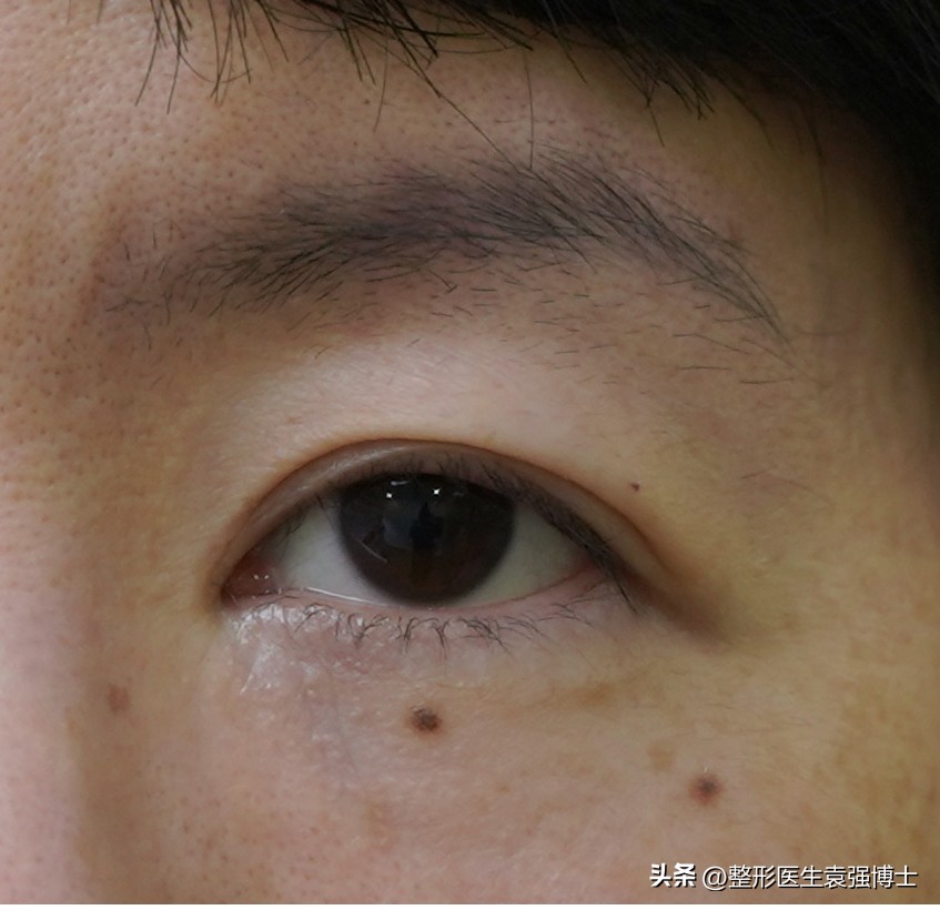 上眼皮耷拉、三角眼、眼皮松，医生说这两种方法很实用