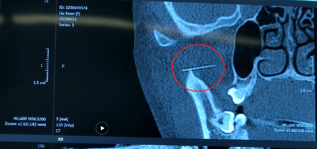银针断在体内的征兆,银针断针处理