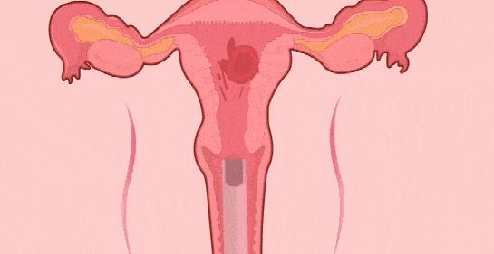 什么是超导可视无痛人流,什么是可视无痛人流用什么工具