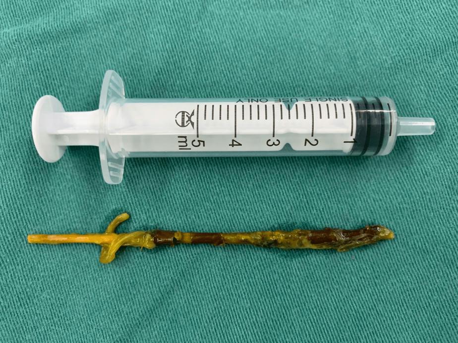 螺母、回形针、小木棍!孩子你还有啥不敢吞?