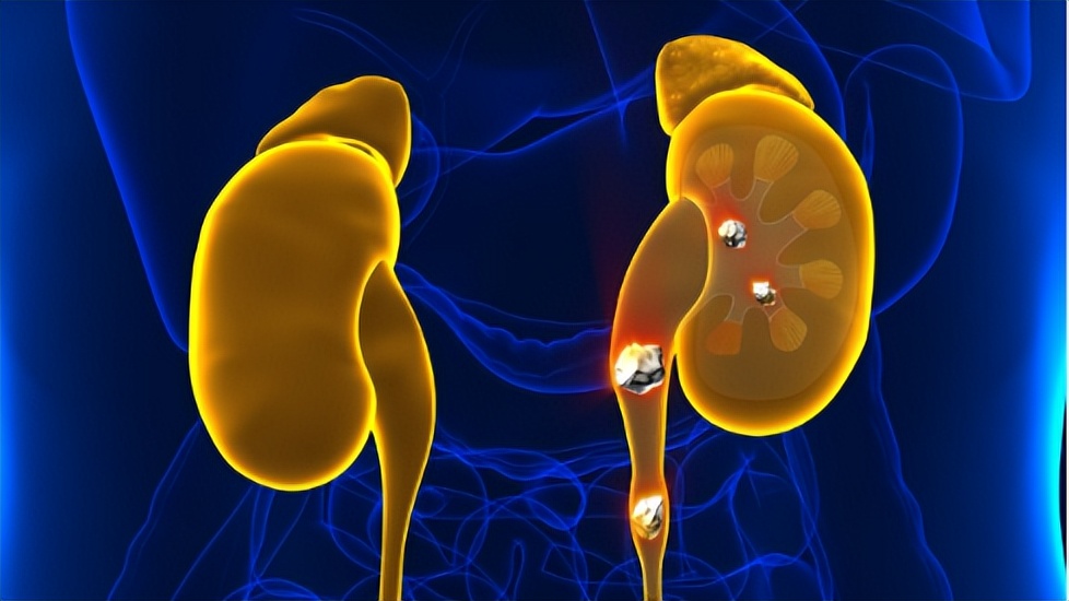 肾结石不能吃鸡蛋吗需要注意什么,肾结石鸡蛋不能吃还能吃什么