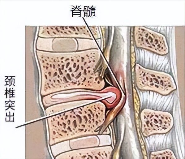 长期右腿承重会导致哪边肩高,长期下肢酸胀怎么回事