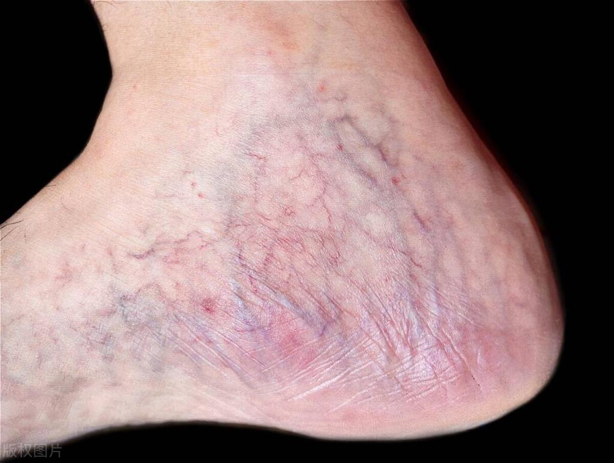 医生腿上有血筋是怎么回事,人的腿上有红血丝是怎么回事呢