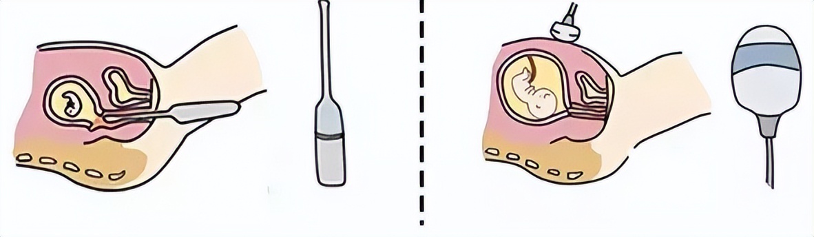 试管婴儿要做阴超不能做b超吗,试管前三维b超具体检查什么