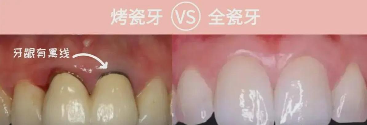 做了根管治疗的牙劈了怎么办,根管治疗以后牙劈了还能再补吗