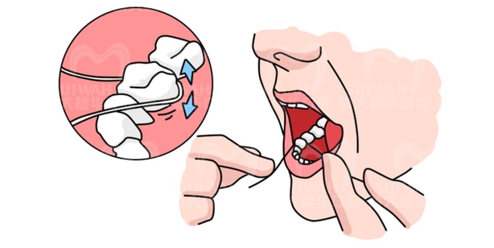 很久没刷牙有牙斑怎么去除,牙齿长了小黑点能靠刷牙解决吗